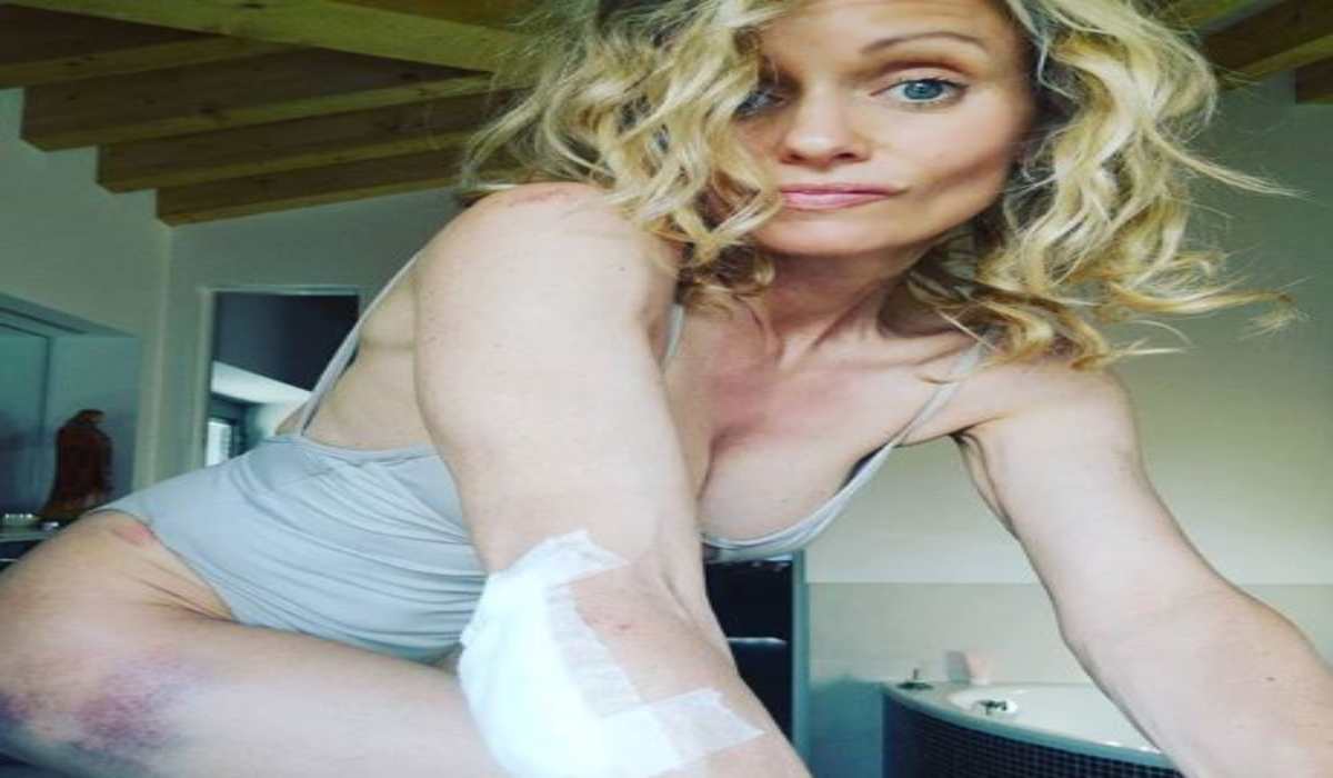 Justine Mattera posta su Instagram i segni di una caduta dalla bicicletta