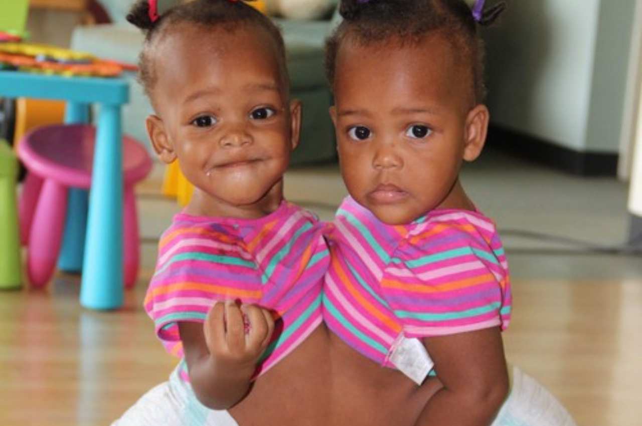 gemelle siamesi maria teresa