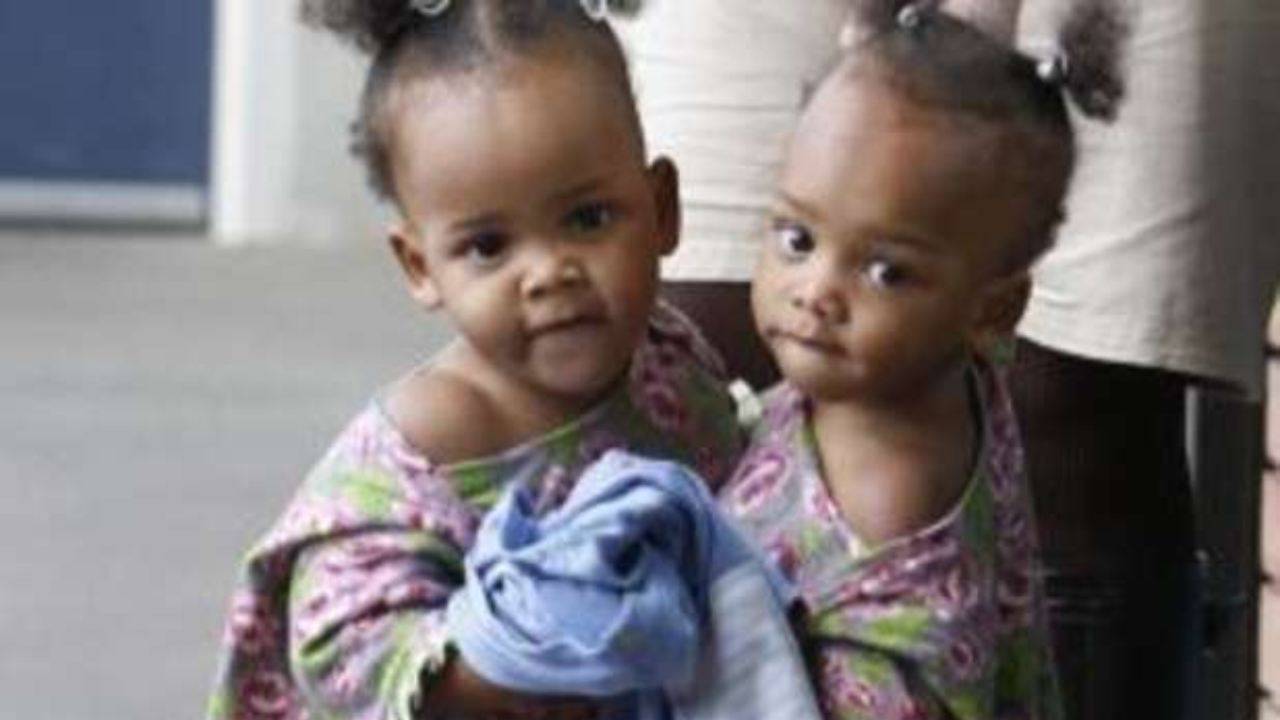 maria teresa gemelle siamesi