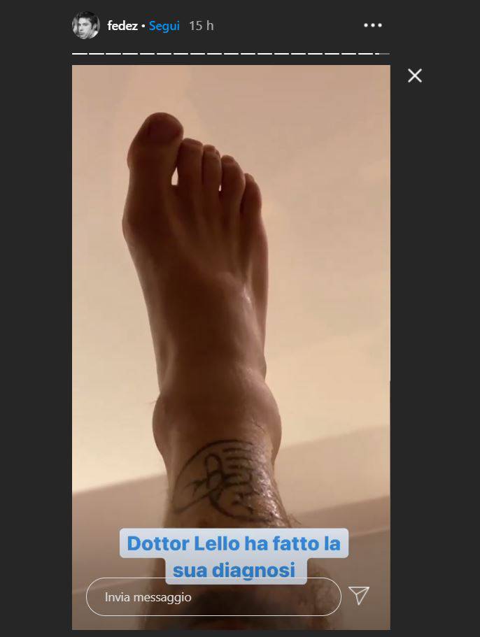 fedez piede rotto